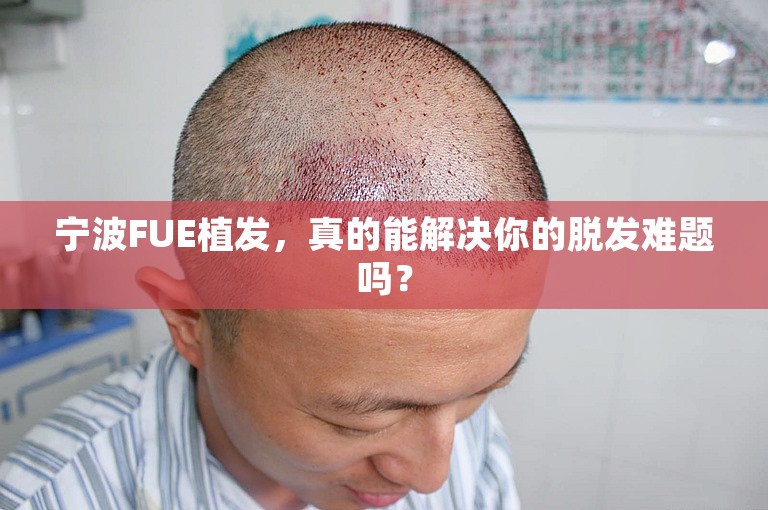 宁波FUE植发，真的能解决你的脱发难题吗？