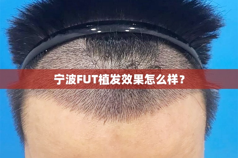 宁波FUT植发效果怎么样？