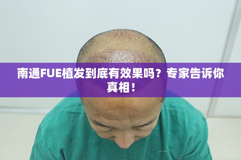 南通FUE植发到底有效果吗？专家告诉你真相！