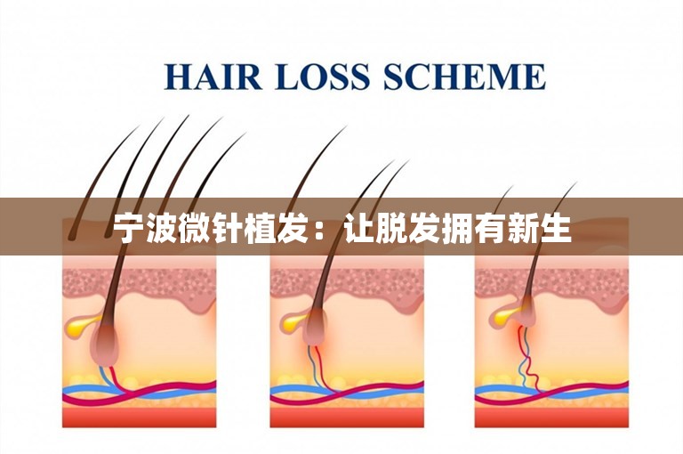 宁波微针植发：让脱发拥有新生
