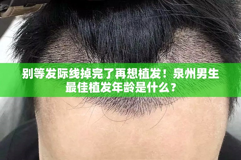 别等发际线掉完了再想植发！泉州男生最佳植发年龄是什么？