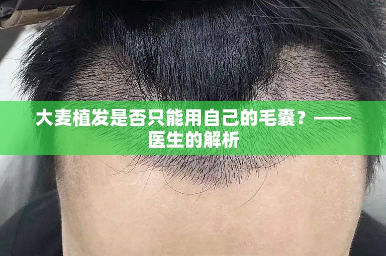 大麦植发是否只能用自己的毛囊？——医生的解析