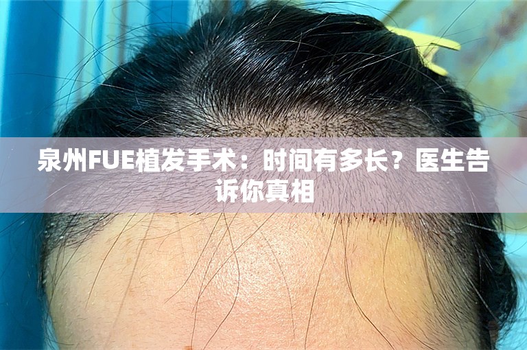 泉州FUE植发手术：时间有多长？医生告诉你真相