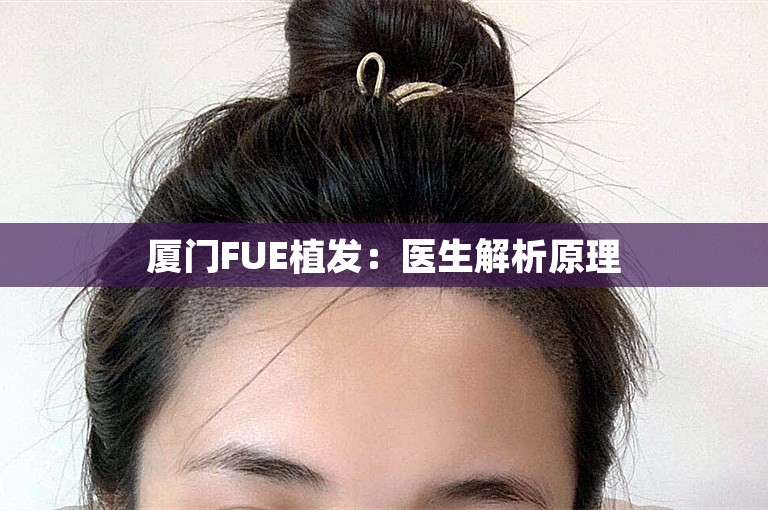 厦门FUE植发：医生解析原理