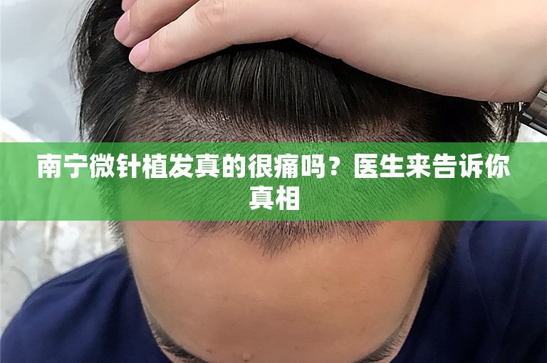 南宁微针植发真的很痛吗？医生来告诉你真相