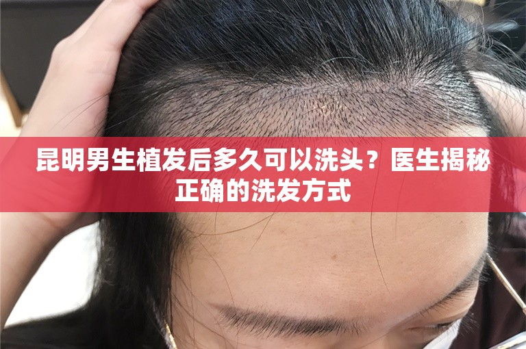 昆明男生植发后多久可以洗头？医生揭秘正确的洗发方式