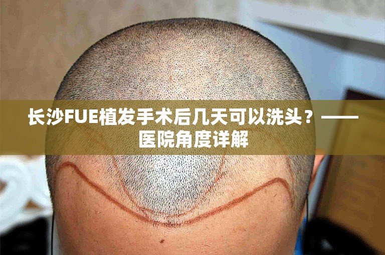 长沙FUE植发手术后几天可以洗头？——医院角度详解