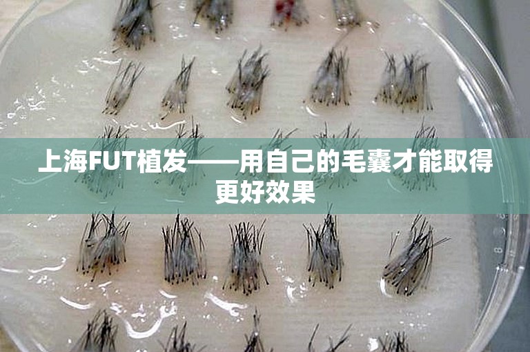 上海FUT植发——用自己的毛囊才能取得更好效果