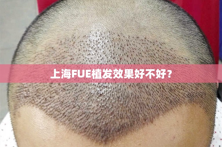 上海FUE植发效果好不好？