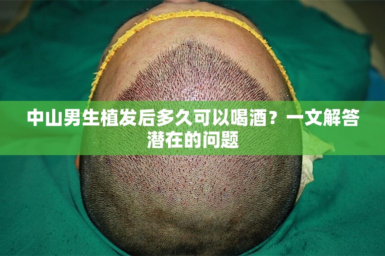 中山男生植发后多久可以喝酒？一文解答潜在的问题