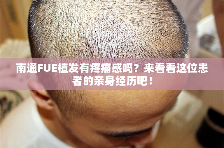 南通FUE植发有疼痛感吗？来看看这位患者的亲身经历吧！