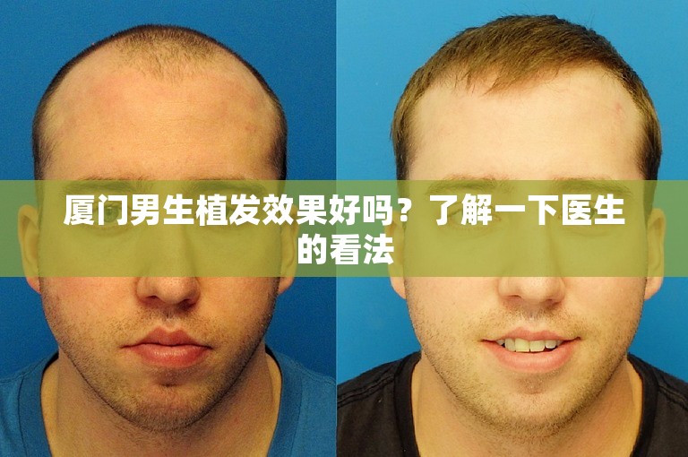 厦门男生植发效果好吗？了解一下医生的看法