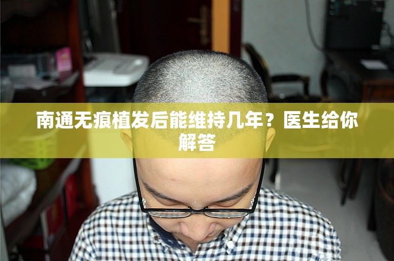 南通无痕植发后能维持几年？医生给你解答