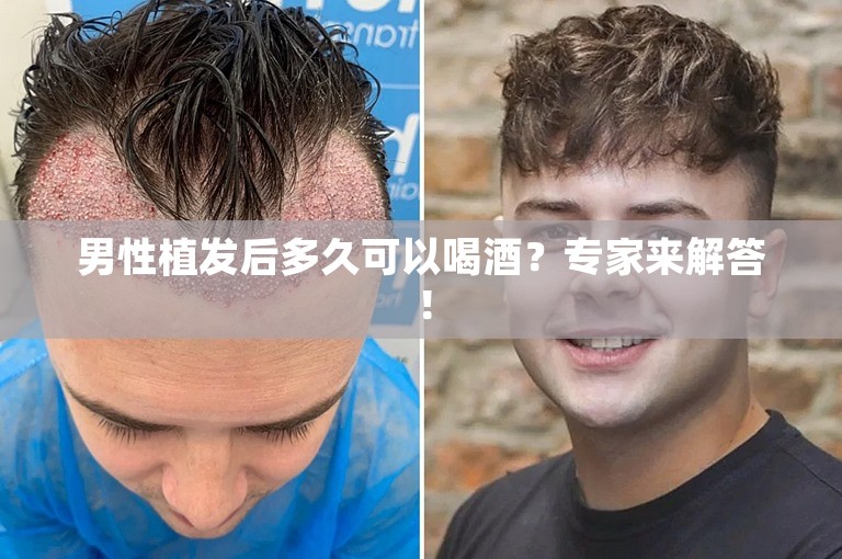 男性植发后多久可以喝酒？专家来解答！