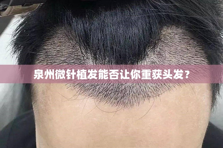 泉州微针植发能否让你重获头发？