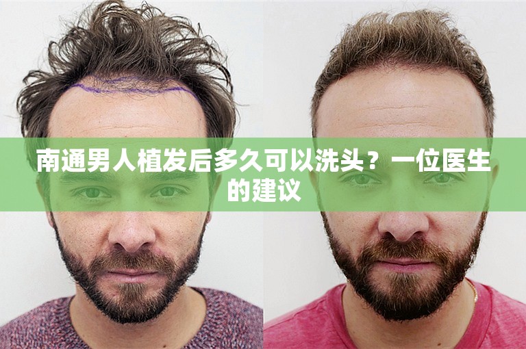 南通男人植发后多久可以洗头？一位医生的建议