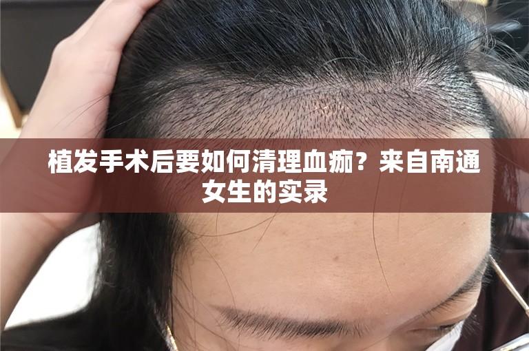 植发手术后要如何清理血痂？来自南通女生的实录