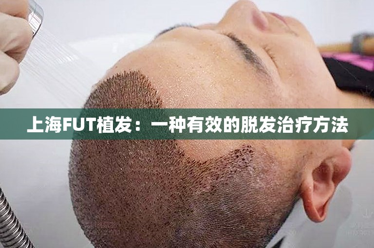 上海FUT植发：一种有效的脱发治疗方法