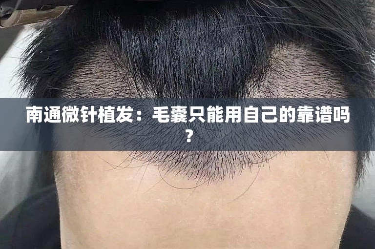 南通微针植发：毛囊只能用自己的靠谱吗？