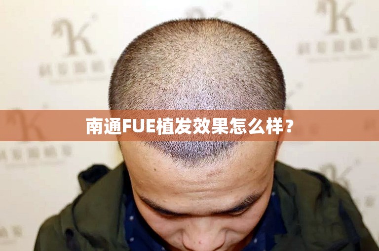 南通FUE植发效果怎么样？