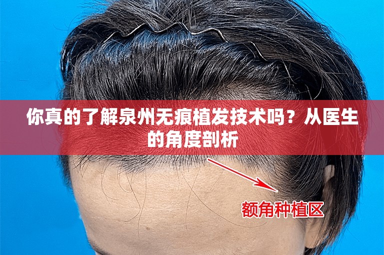 你真的了解泉州无痕植发技术吗？从医生的角度剖析