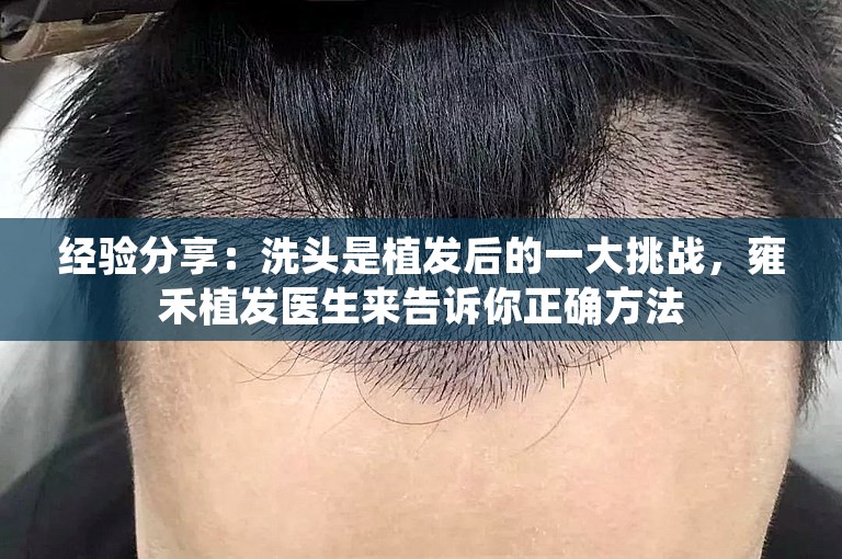 经验分享：洗头是植发后的一大挑战，雍禾植发医生来告诉你正确方法