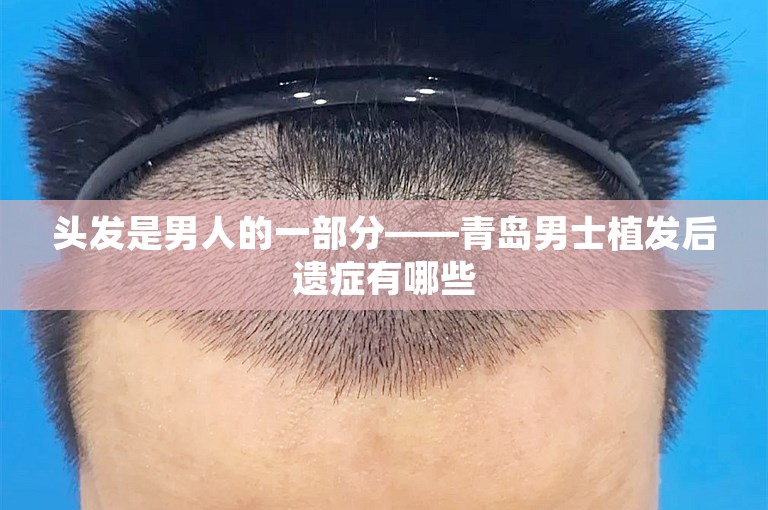 头发是男人的一部分——青岛男士植发后遗症有哪些