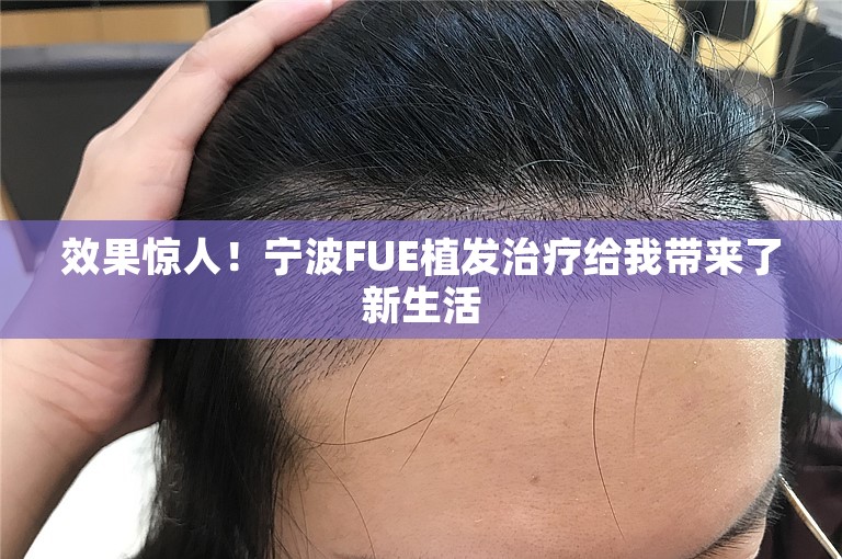 效果惊人！宁波FUE植发治疗给我带来了新生活