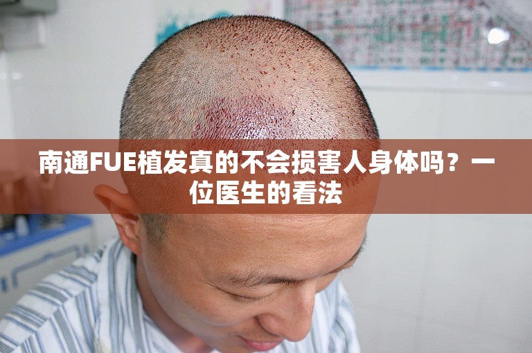 南通FUE植发真的不会损害人身体吗？一位医生的看法