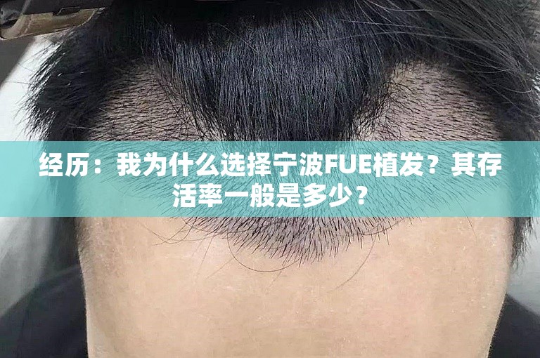 经历：我为什么选择宁波FUE植发？其存活率一般是多少？