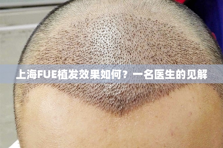 上海FUE植发效果如何？一名医生的见解