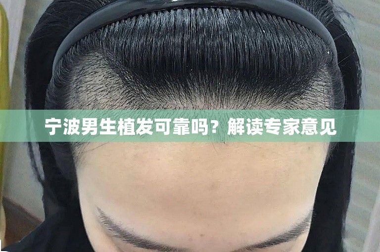 宁波男生植发可靠吗？解读专家意见