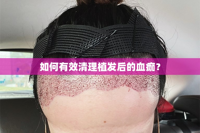 如何有效清理植发后的血痂？