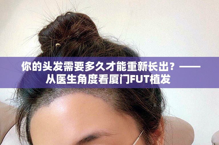  你的头发需要多久才能重新长出？——从医生角度看厦门FUT植发 