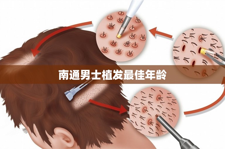 南通男士植发最佳年龄