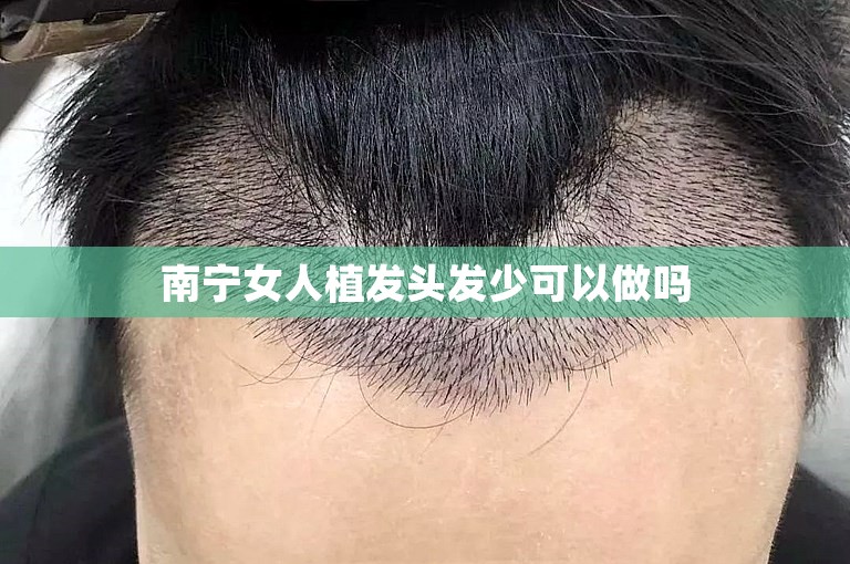 南宁女人植发头发少可以做吗