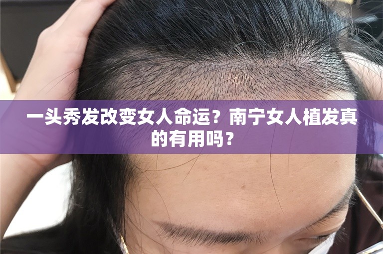 一头秀发改变女人命运？南宁女人植发真的有用吗？