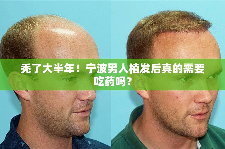 秃了大半年！宁波男人植发后真的需要吃药吗？