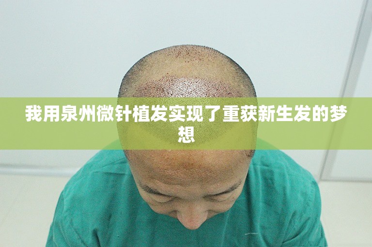 我用泉州微针植发实现了重获新生发的梦想