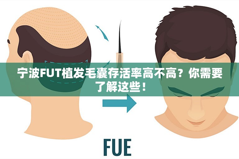 宁波FUT植发毛囊存活率高不高？你需要了解这些！