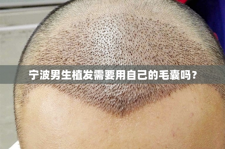 宁波男生植发需要用自己的毛囊吗？