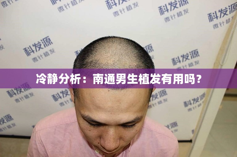 冷静分析：南通男生植发有用吗？