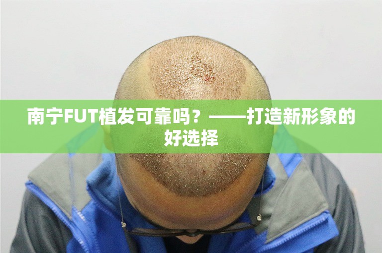 南宁FUT植发可靠吗？——打造新形象的好选择