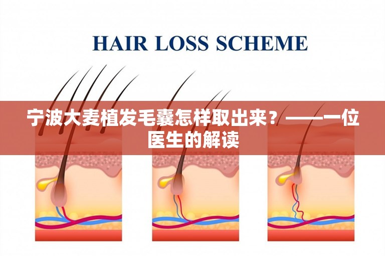 宁波大麦植发毛囊怎样取出来？——一位医生的解读