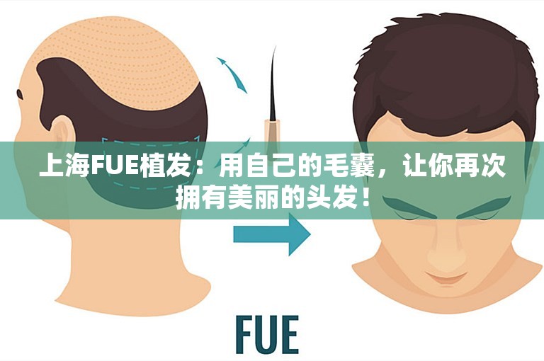 上海FUE植发：用自己的毛囊，让你再次拥有美丽的头发！