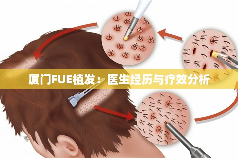 厦门FUE植发：医生经历与疗效分析