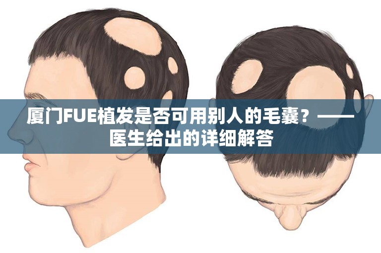 厦门FUE植发是否可用别人的毛囊？——医生给出的详细解答