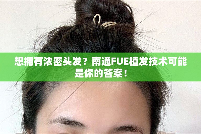 想拥有浓密头发？南通FUE植发技术可能是你的答案！