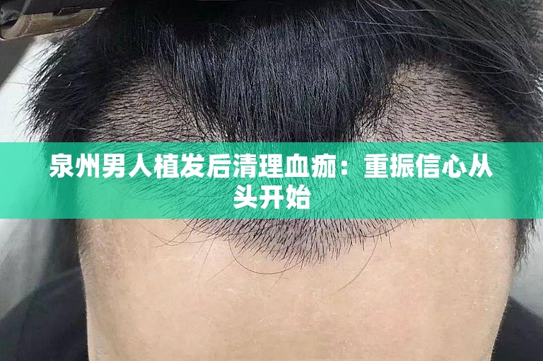 泉州男人植发后清理血痂：重振信心从头开始