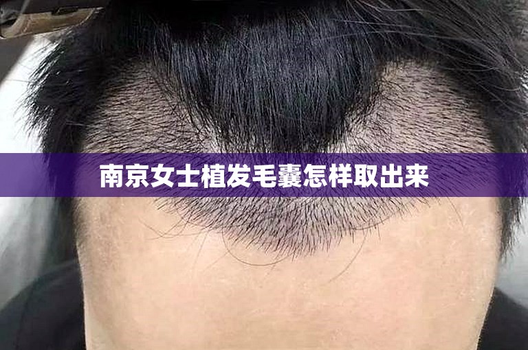 南京女士植发毛囊怎样取出来